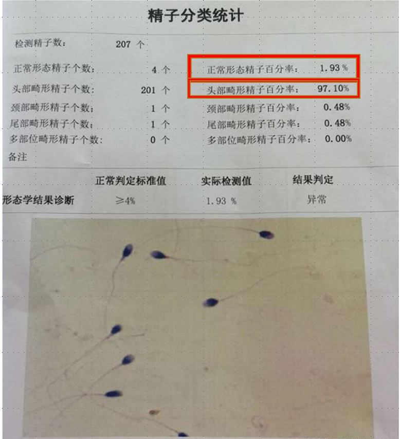 检查报告上精子畸形率有什么意义在整个过程中,精子会受到很多不良