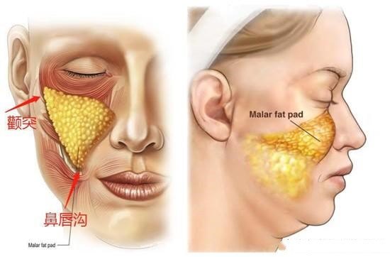 颊脂垫的位置图片图片