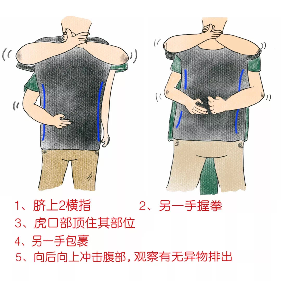 海姆立克急救法