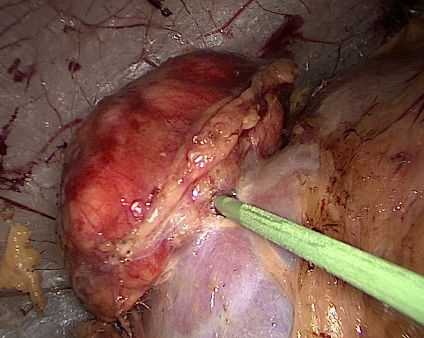 手术指证:外院mri示:左肾上极可见一直径约4.8cm肿块,考虑肾错构瘤.