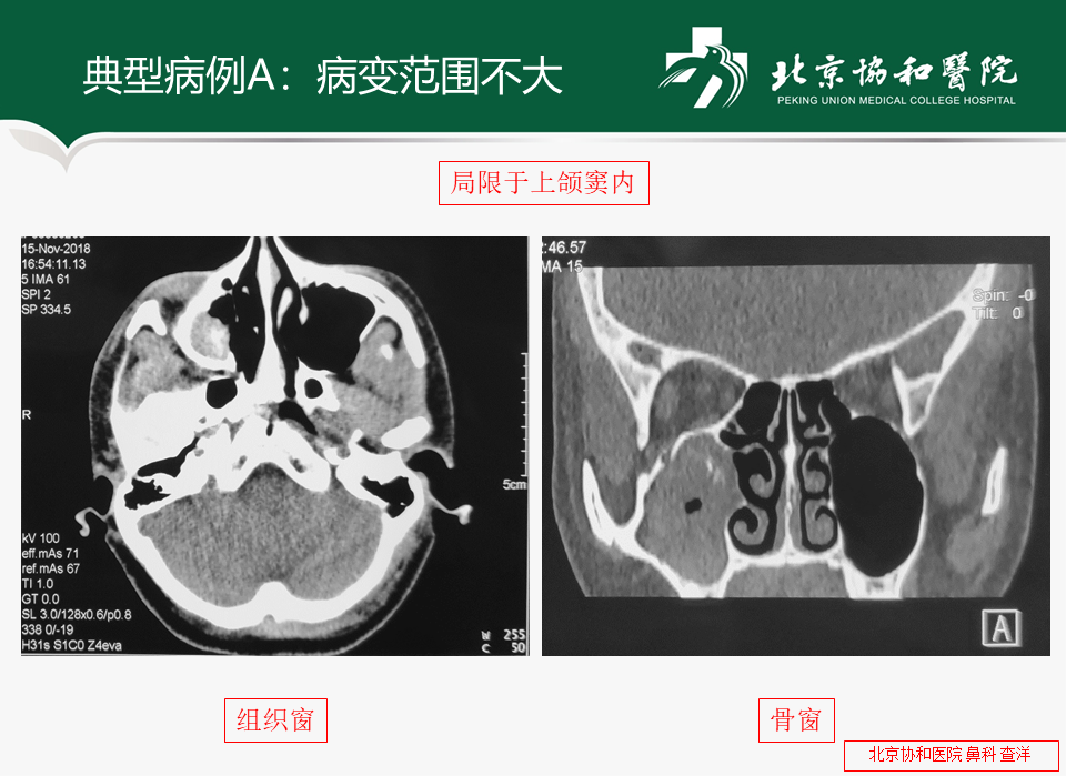 真菌性上颌窦炎的临床处理—内附鼻内镜手术视频