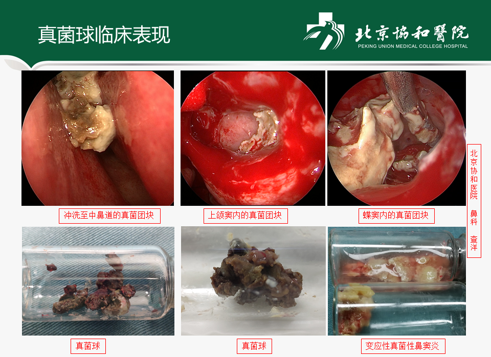 真菌性鼻窦炎患者手术常见问题及注意事项