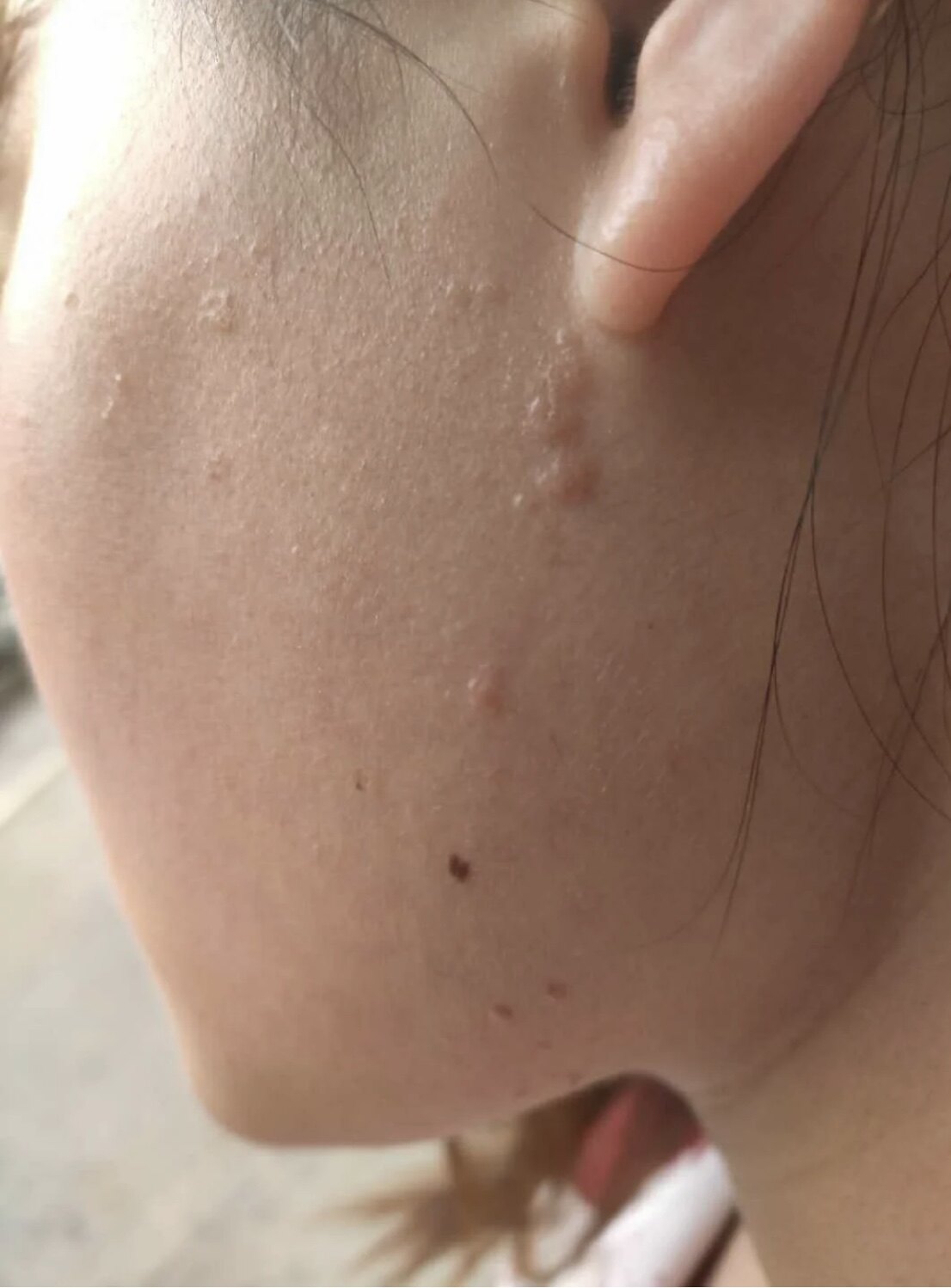 宝宝长了 瘊子 怎么办 谈谈儿童病毒疣 疣