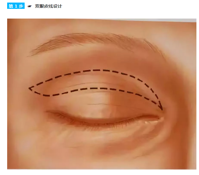 全切双眼皮手术设计全过程图解 - 好大夫在线