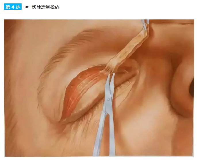 全切双眼皮手术设计全过程图解 - 好大夫在线