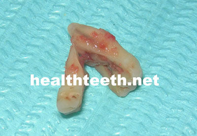 臼齿侧面裂缝图片
