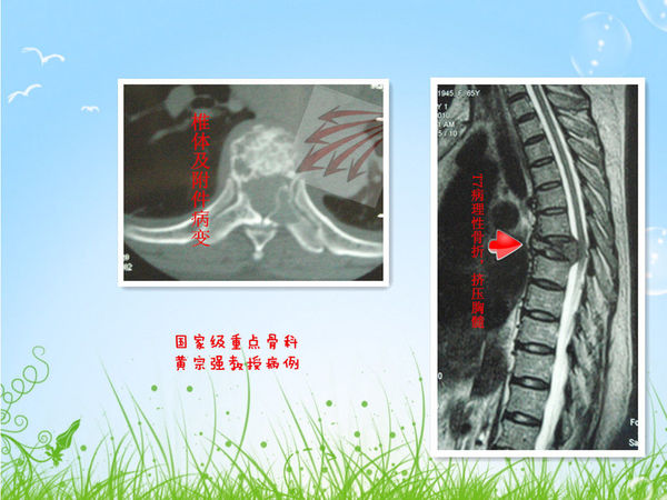 t7椎体肿瘤的整块切除 - 好大夫在线