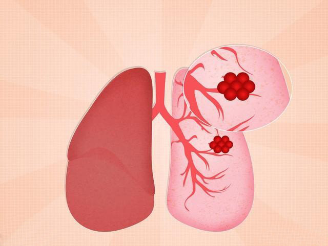 肺部结节 肺部结节