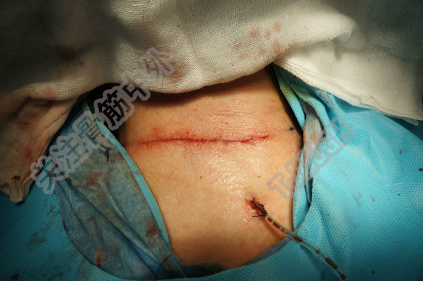 今日手术-颈椎前路减压间盘摘除植骨融合 - 好大夫在线