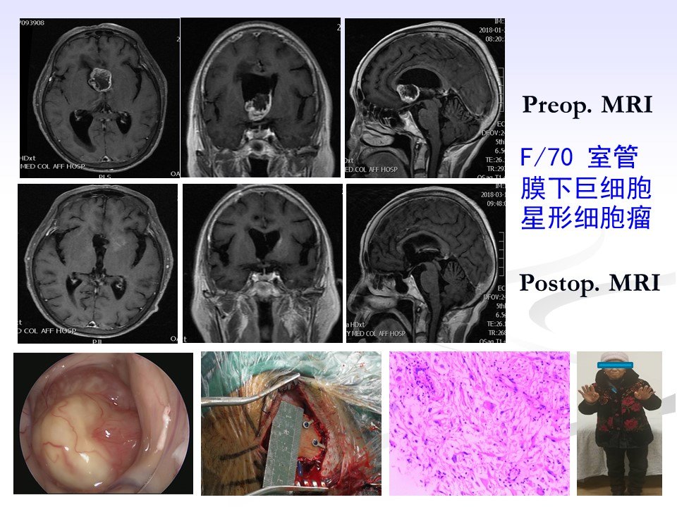 神经内镜endoport经右中回入路侧脑室室间孔肿瘤