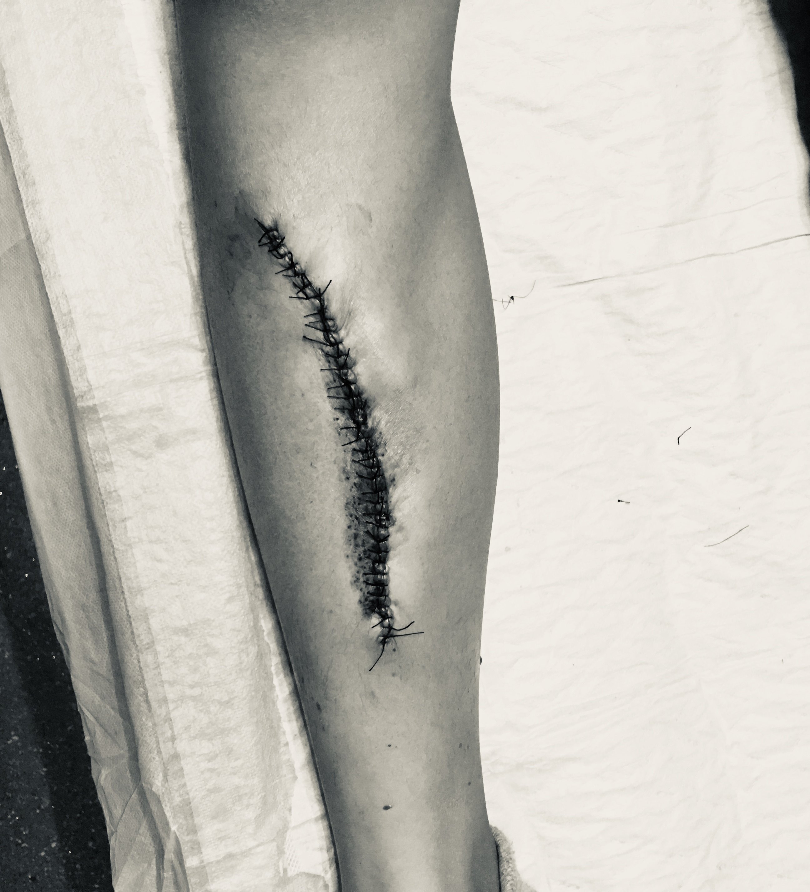 分次切除是一个不错的选择._手术 - 好大夫在线