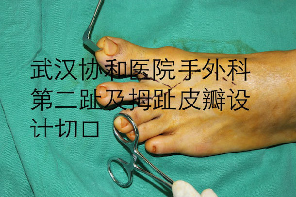 2015年2月28日完成的一例第二足趾移植,中指再造术