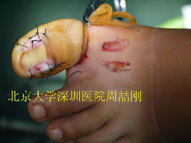 嵌甲甲沟炎——甲床成形术的手术过程及术后随访 - 好大夫在线