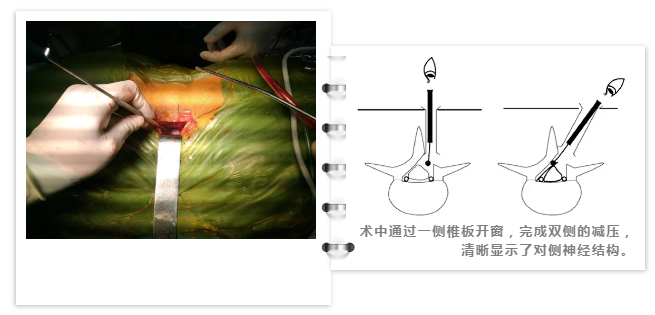 這種老年人常見腰部疾病不開大刀不打鋼釘只要一個小切口