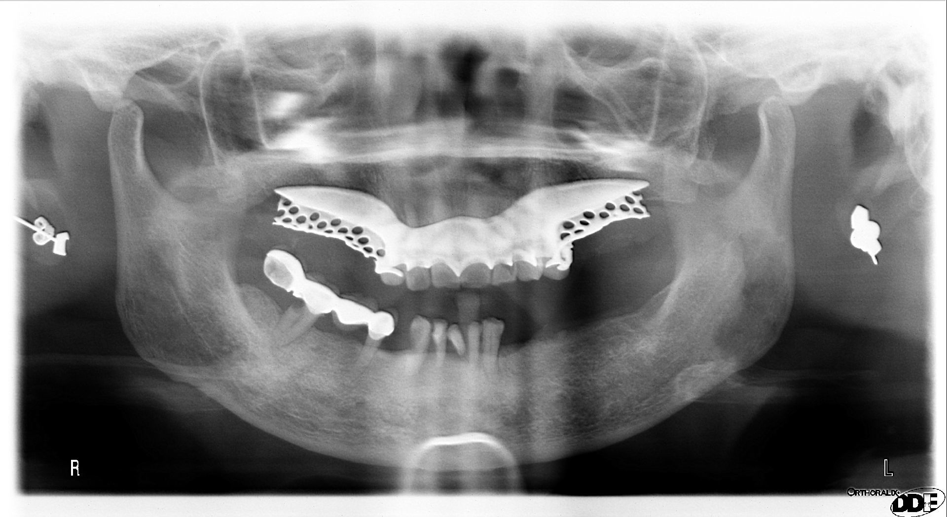 正常牙齿侧面图 x光片图片