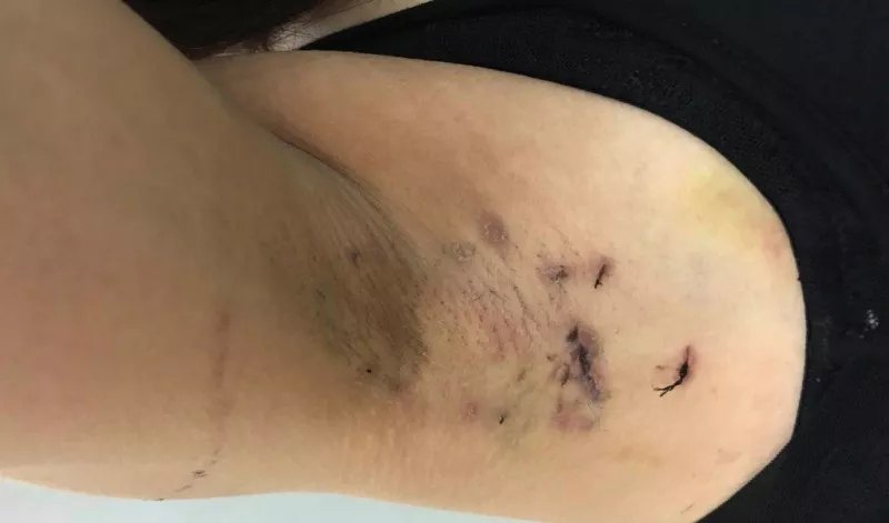 宁波腋臭治疗医院哪家更靠谱?