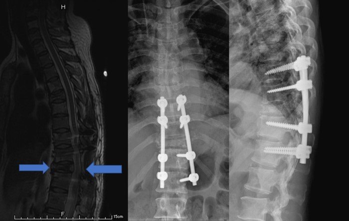 成功治療乳腺癌胸椎多節段病理骨折的案例1例分析