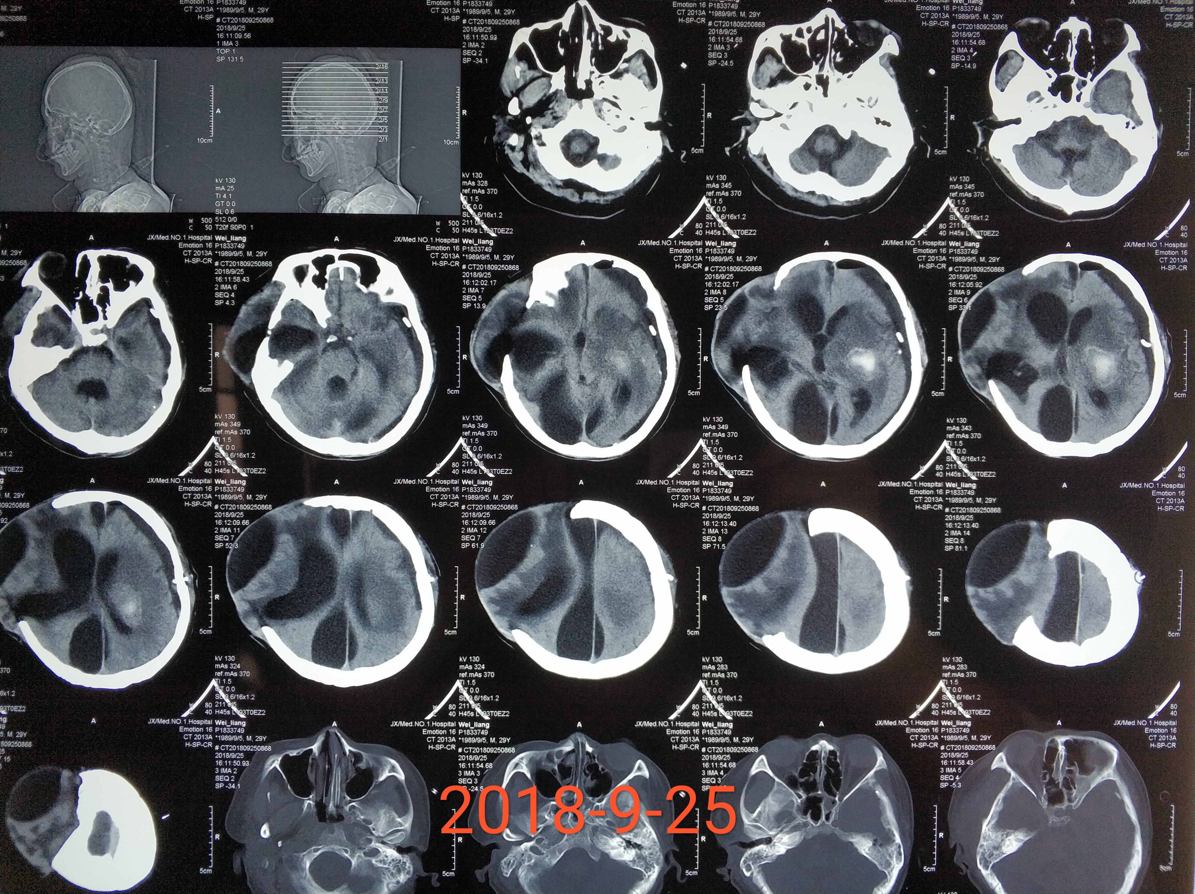 复杂性脑积水硬膜下积液的诊治