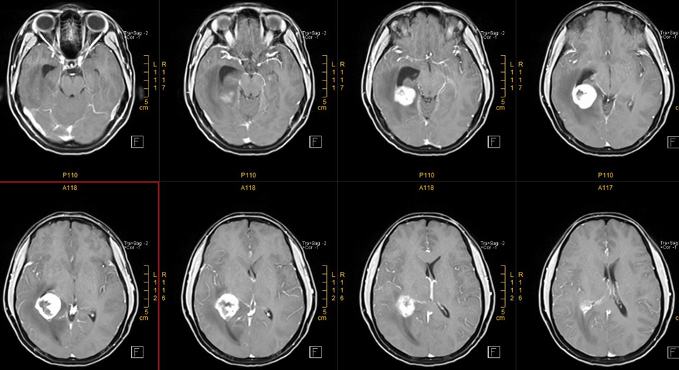 腦室內橫紋肌樣腦膜瘤鎖孔手術一例