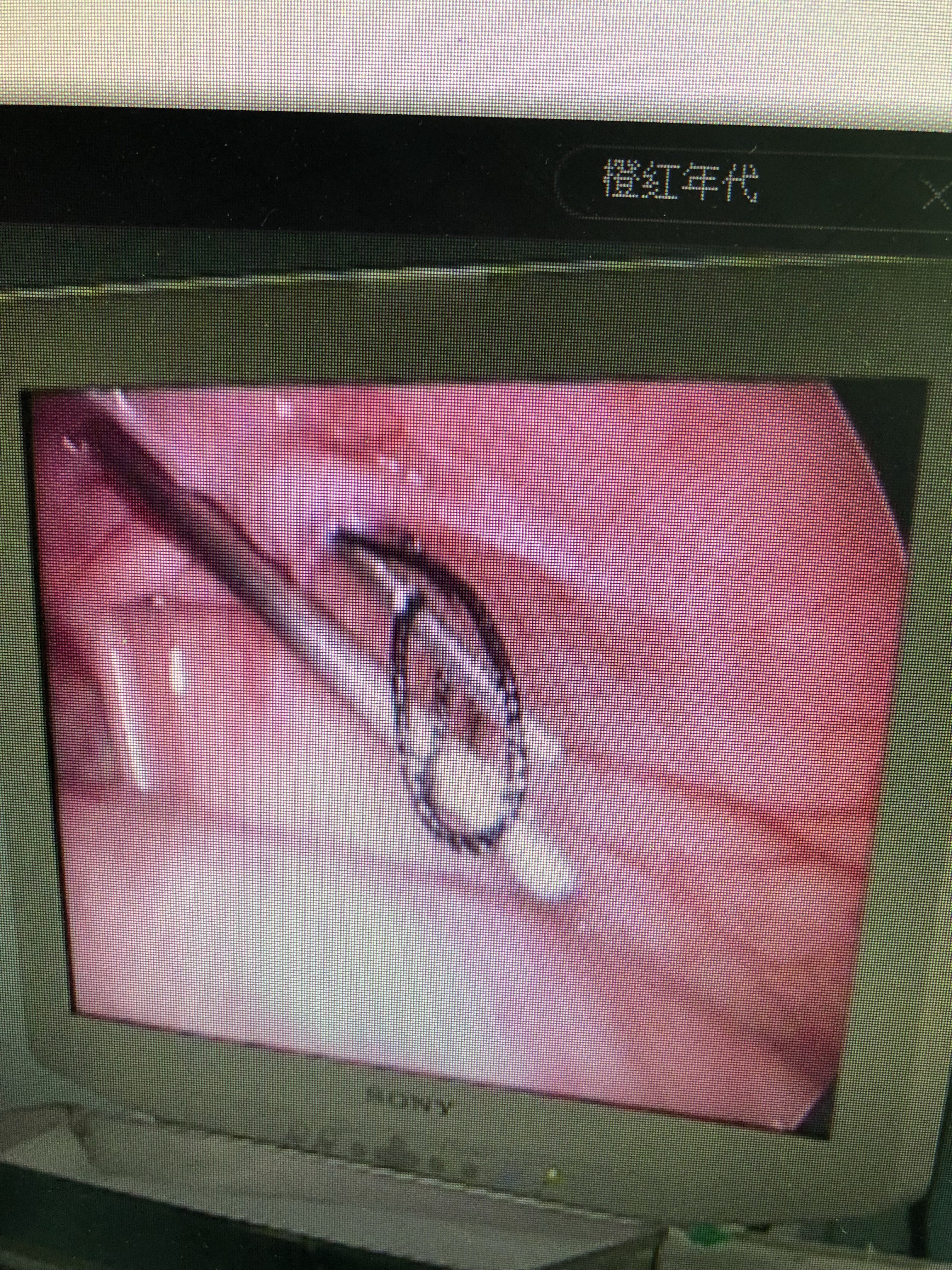 成人丶小儿腹股沟疝(小肠气)现代诊疗方法_腹股沟疝_病因_症状_手术