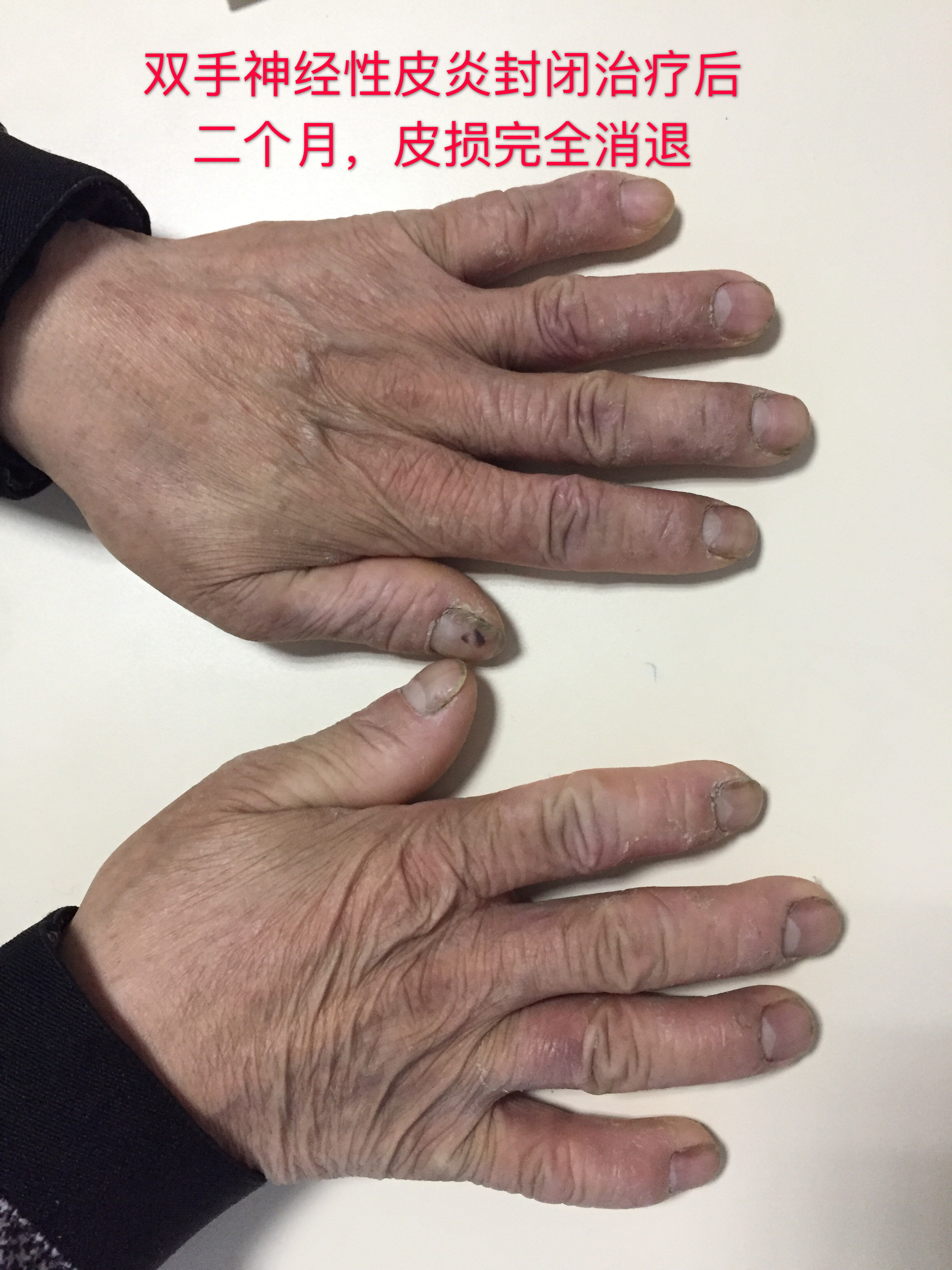 封闭疗法的技巧