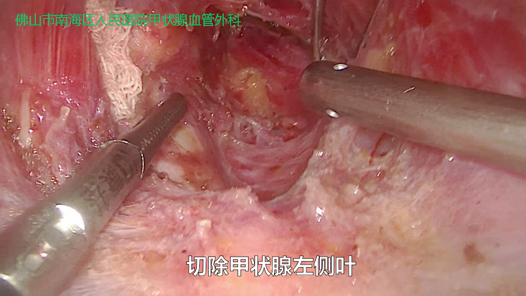 甲状腺内镜微创手术过程科普图片医学恐惧症勿看