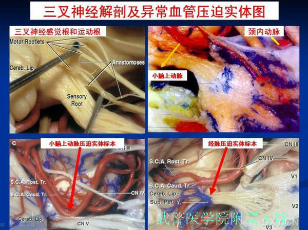 教你看三叉神经痛的解剖图谱