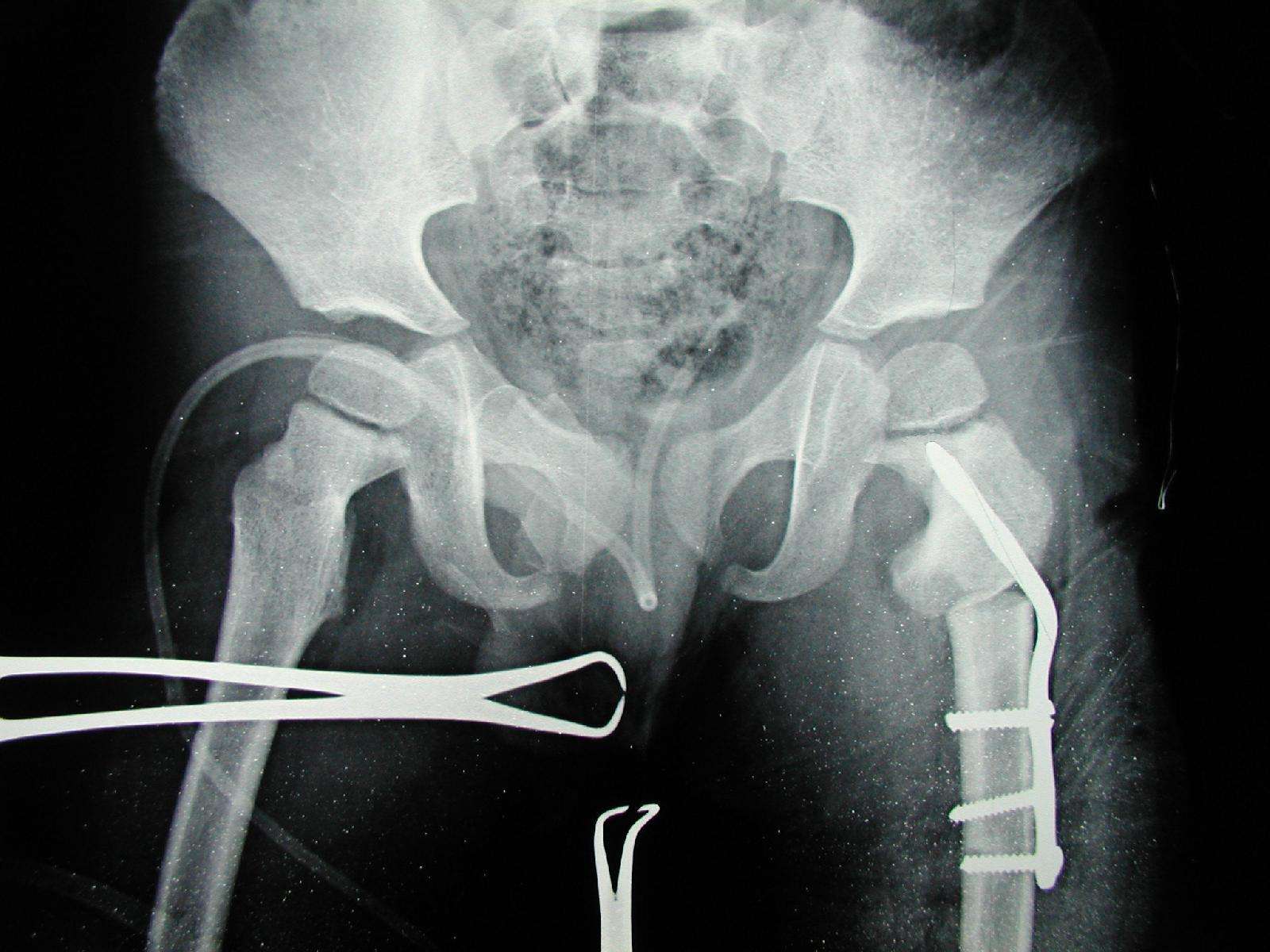 y型截骨术治疗先天性髋内翻