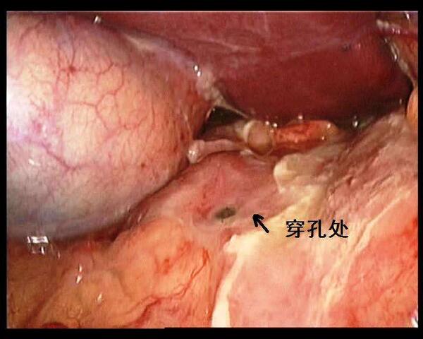 腹腔镜治疗胃十二指肠溃疡穿孔 