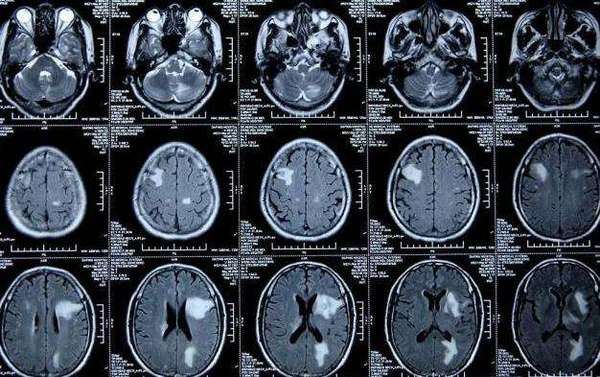 颅脑转移瘤mri特点(网络远程会诊病例)