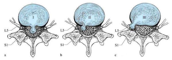 腰椎间盘突出的诊断问题