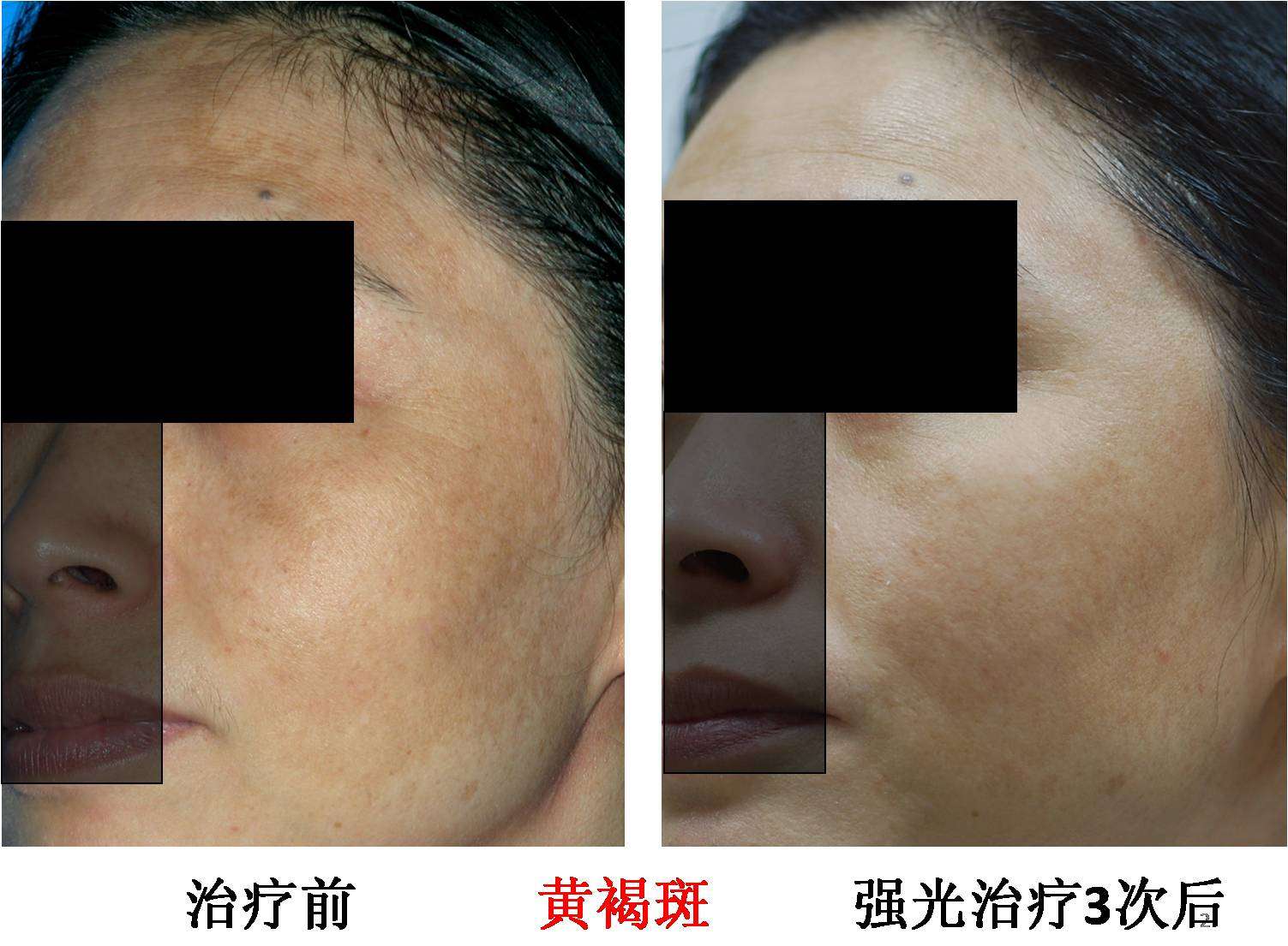 顽固的混合型黄褐斑的治疗