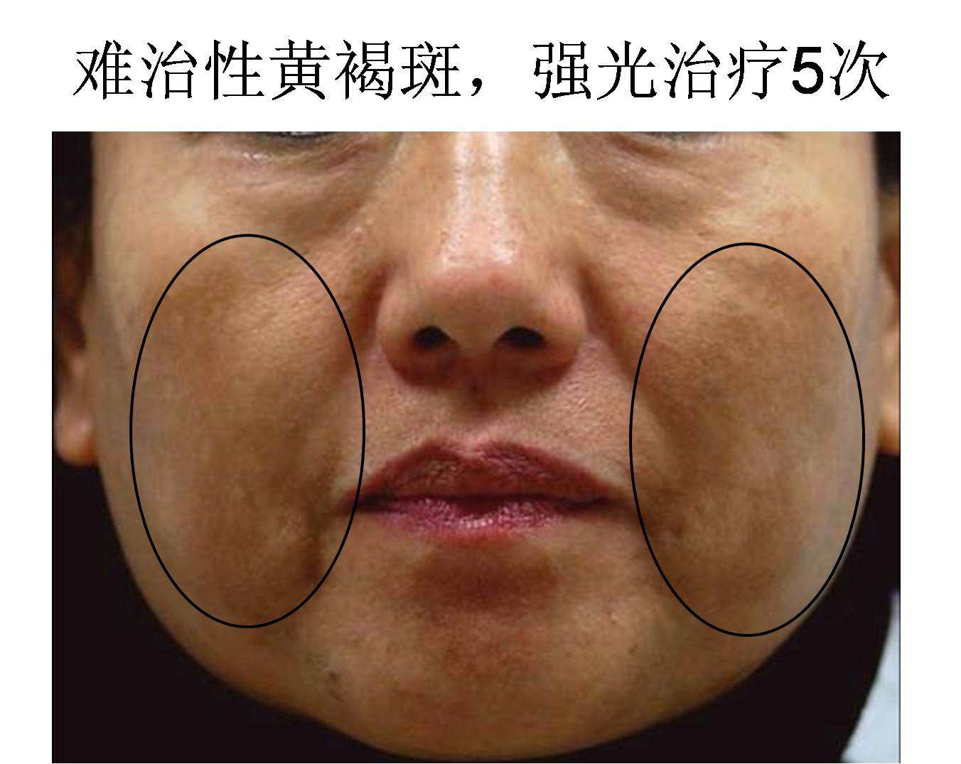 顽固的混合型黄褐斑的治疗