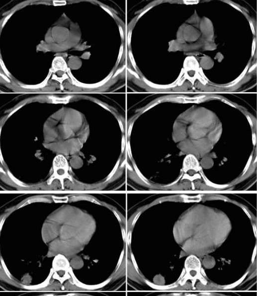球形肺炎(网络远程会诊病例)