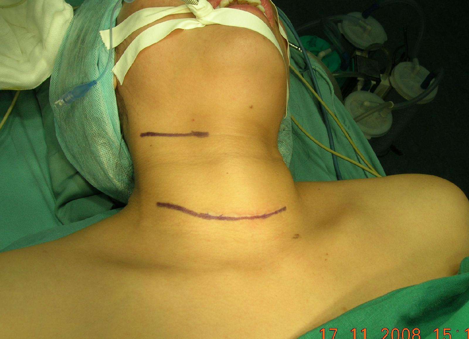 行全颈淋巴结清扫术时常常用l型切口,但由于颈部皮纹是横行的,所以l型