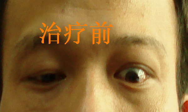 重症甲亢突眼怎么治疗?