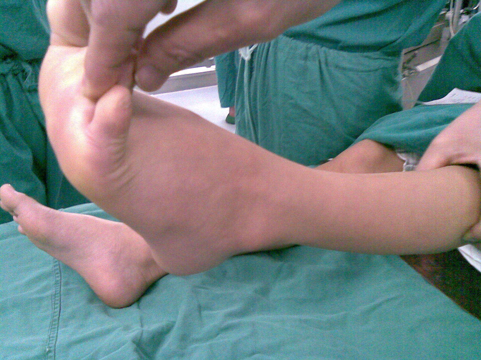 马蹄足合并肢体短缩 - 好大夫在线