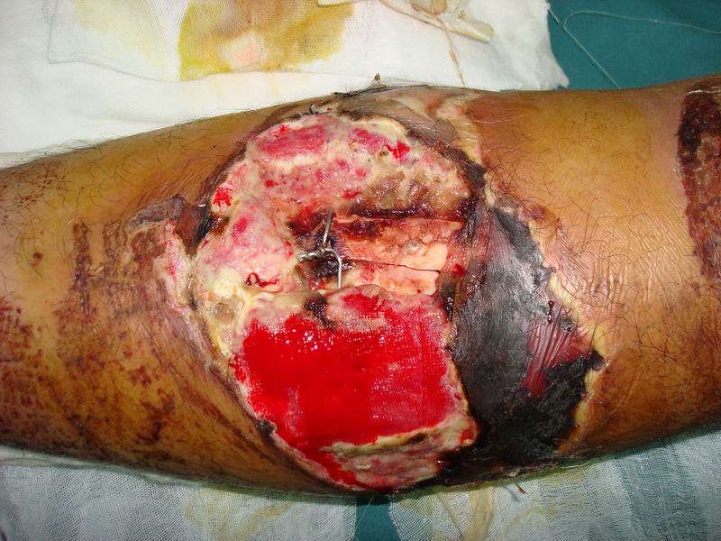 骨质外露肌肉坏死洛阳皮瓣修复 - 好大夫在线