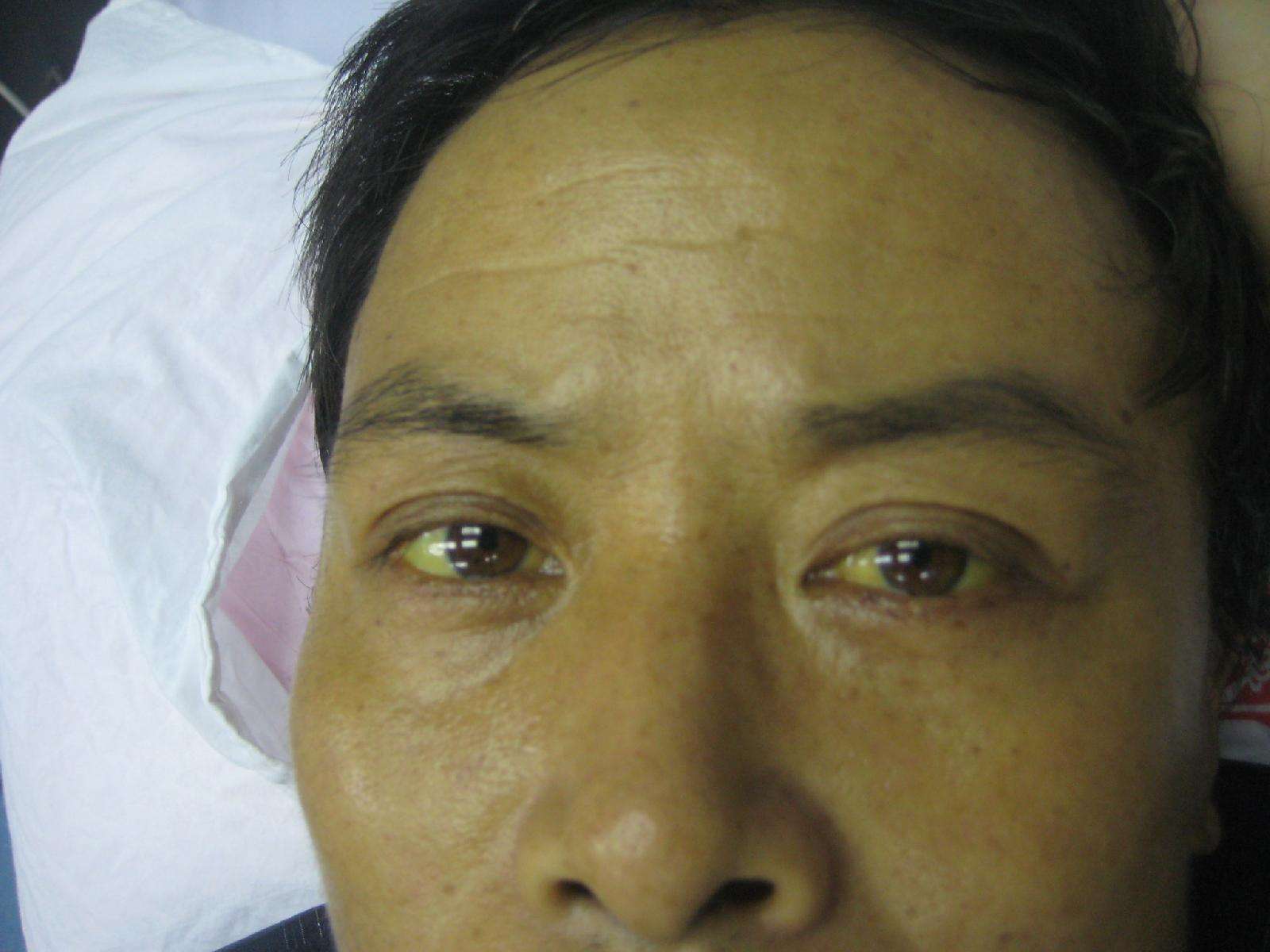 肝癌梗阻性黄疸的治疗