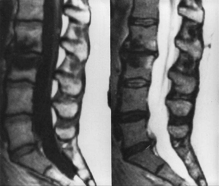 腰椎Modic改变 - 好大夫在线