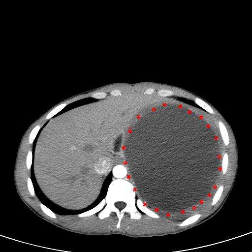 以脾肿大为特点的疾病的手术治疗