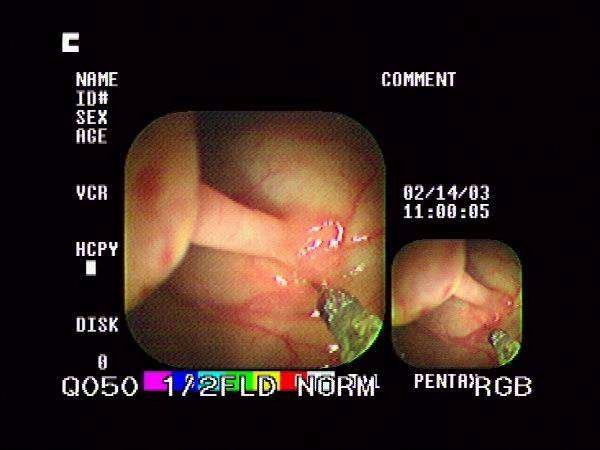 食管息肉,贲门息肉,胃肠管息肉防癌变九招(1)