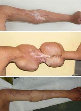 11.下肢皮肤扩张