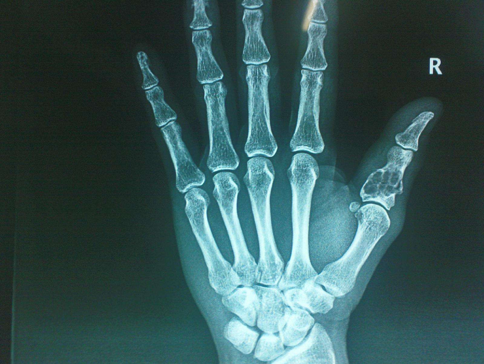 手部内生软骨瘤