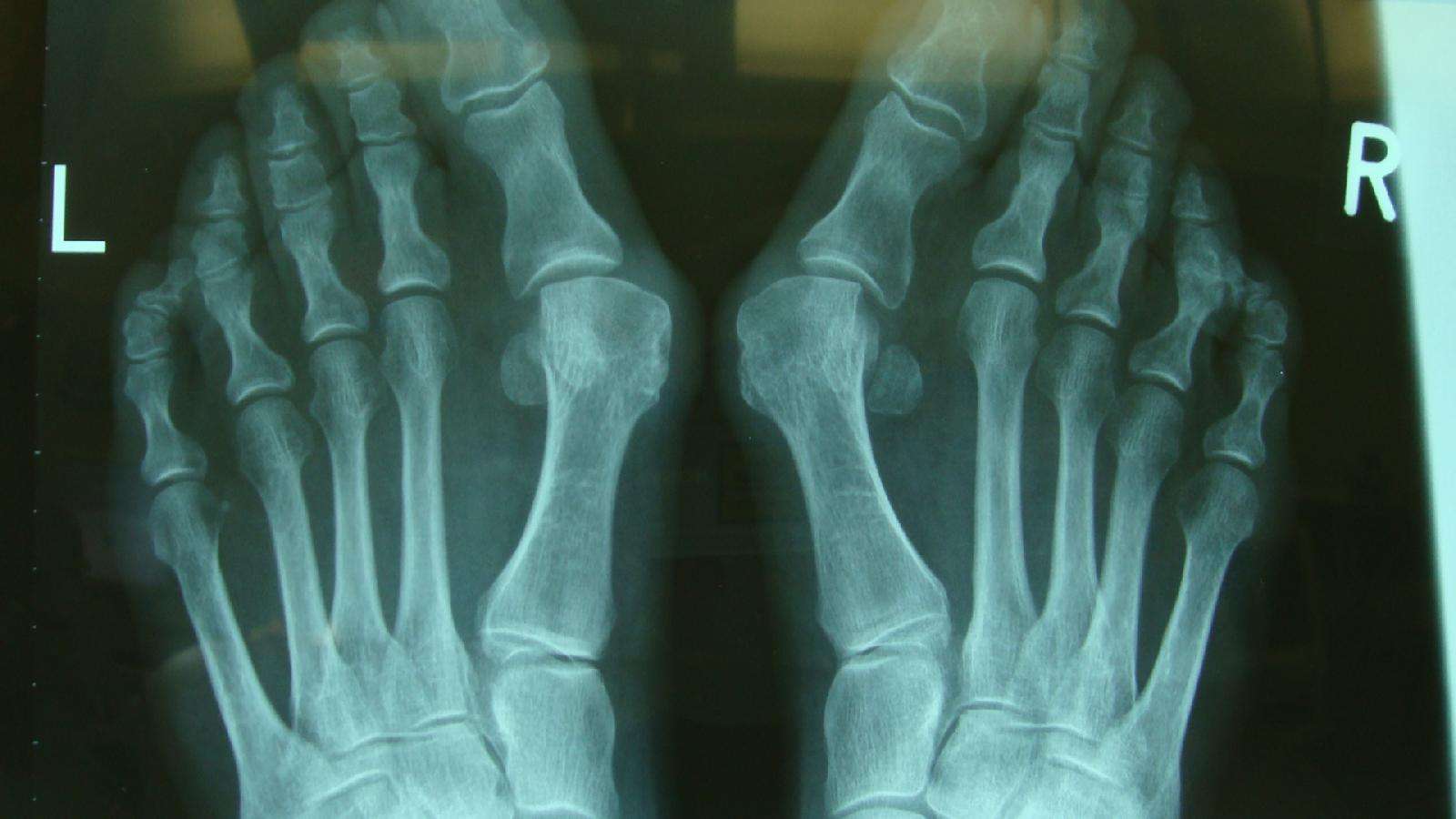 脚骨头x光正常图片图片