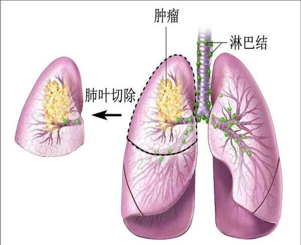 楔形切除:手術切除腫瘤及其周圍的部分正常組織.