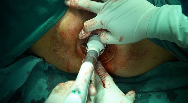 微创术式治愈重度直肠脱垂患者的手术录像截图