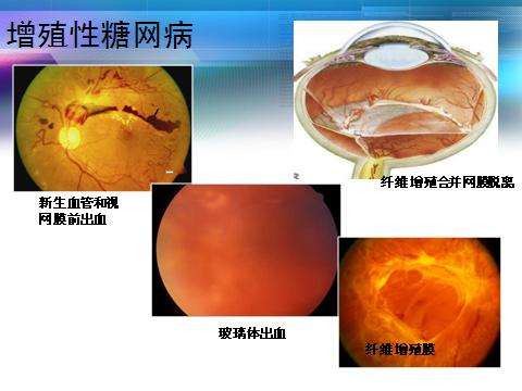 糖尿病视网膜病变 www.haodf.com