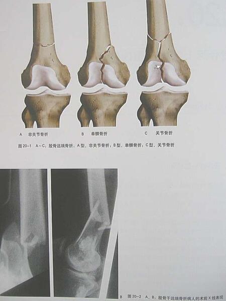 股骨髁间骨折分型图片