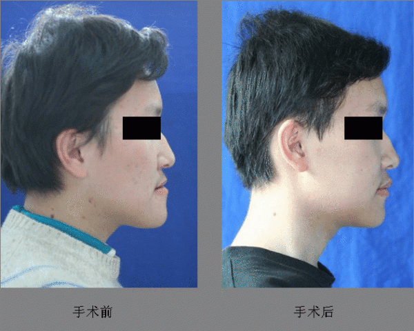 严重的骨性"地包天"需要在成年后进行正畸-整颌手术联合治疗.